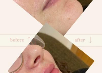 lip filler reading 2