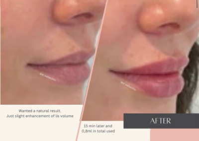 lip filler reading 3