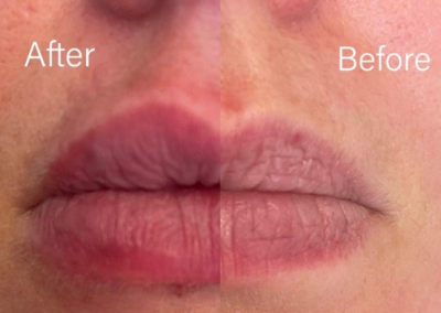 lip filler reading 4
