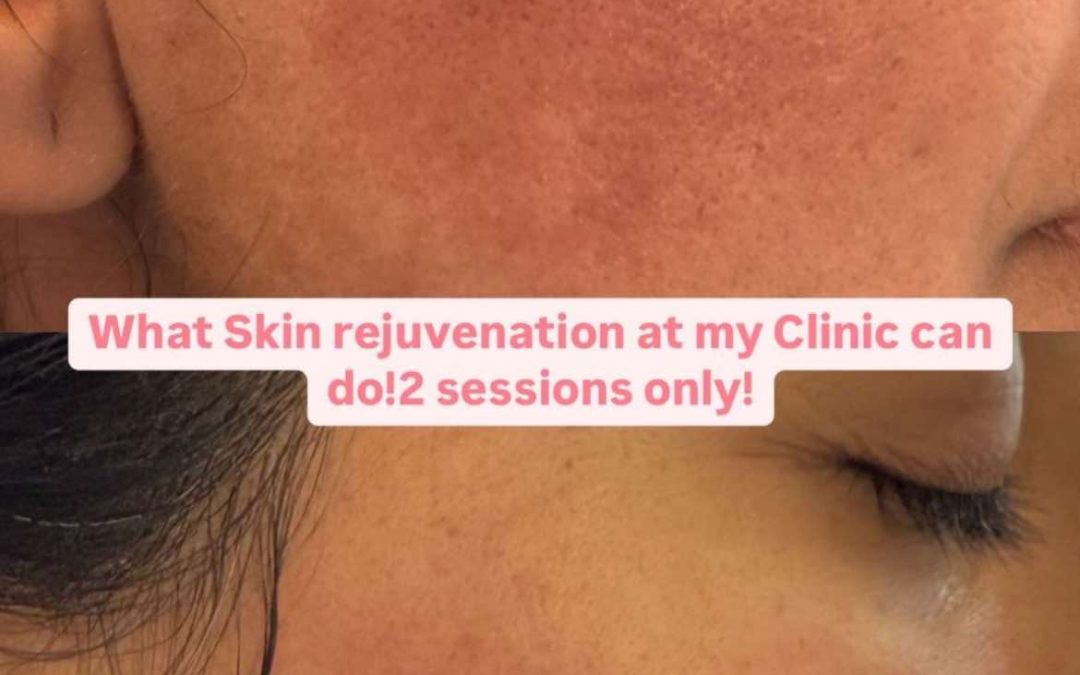 How to Choose the Right Acne Scar Treatment